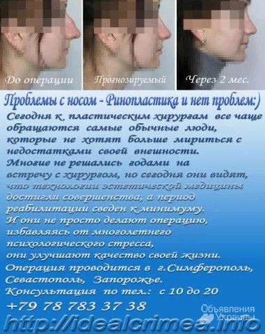 Фото Проблемы с носом - Ринопластика и нет проблем:) Крым.  Цены по прайсу.